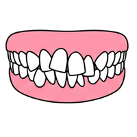 ガタガタ（叢生）