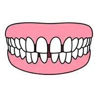 すきっ歯（空隙歯列）